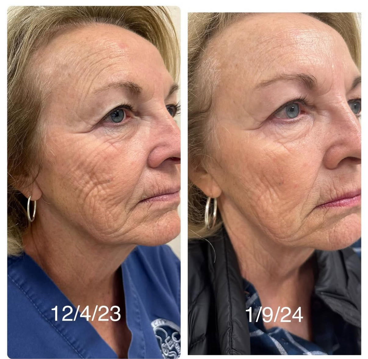 Equinox PRO LED face mask